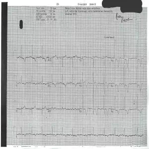 ECG myocarditis